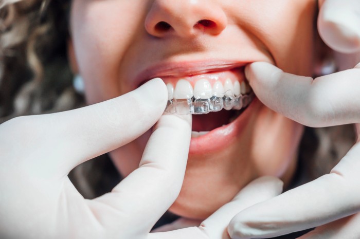 Invisalign