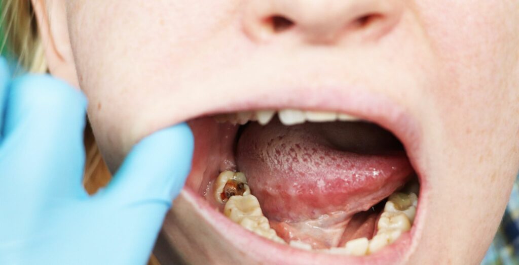 Stages of Dental Cavities