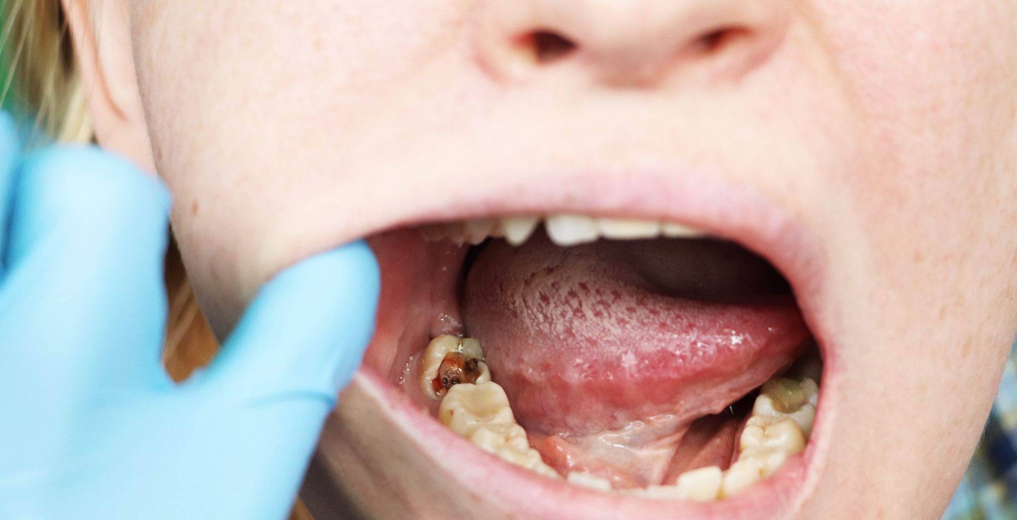 Stages of Dental Cavities
