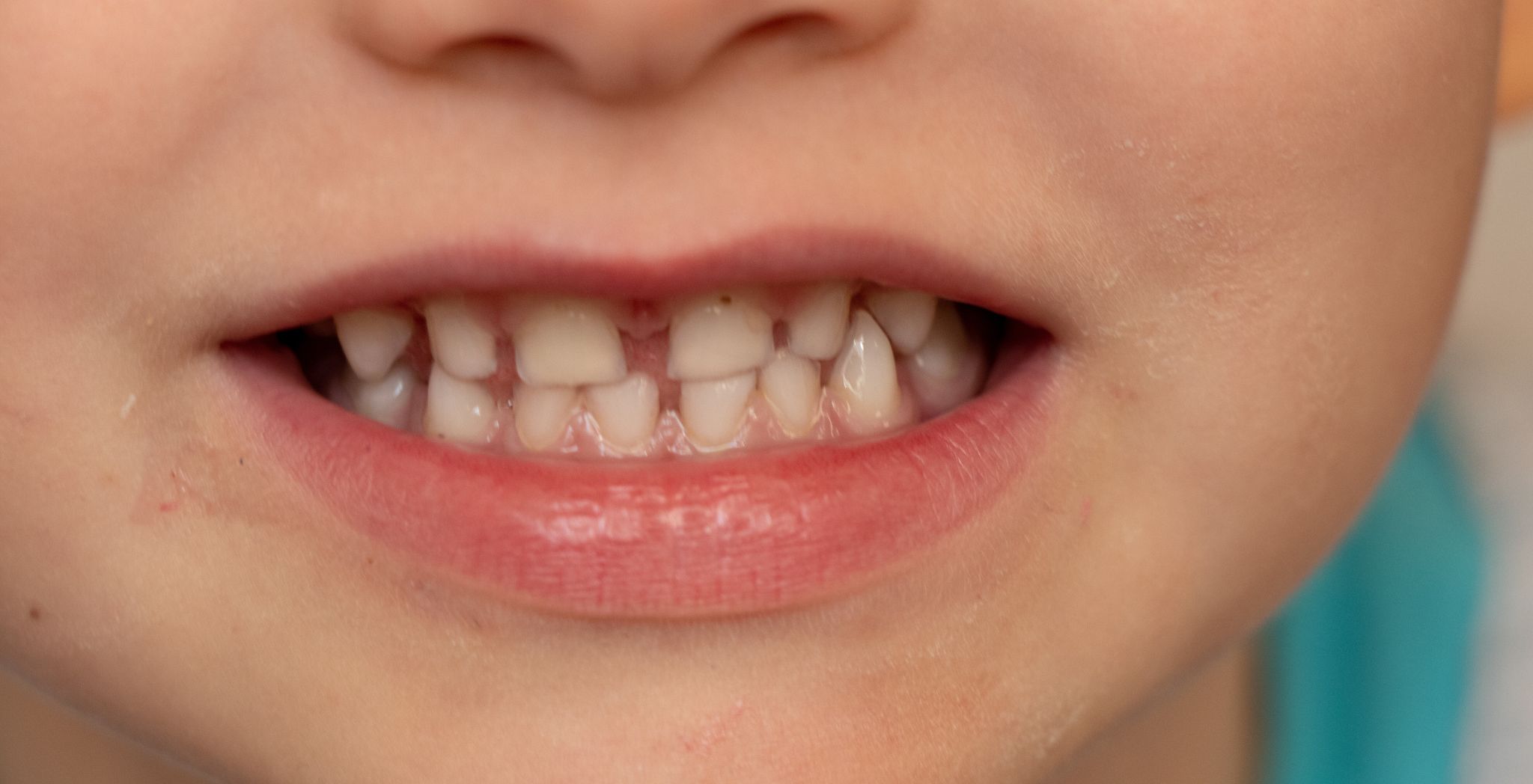 Bruxism in infants, Infant teeth grinding, Baby grinding teeth, Causes of bruxism in babies, Infant night-time teeth grinding, Signs of bruxism in infants, Baby sleep bruxism, Managing infant bruxism