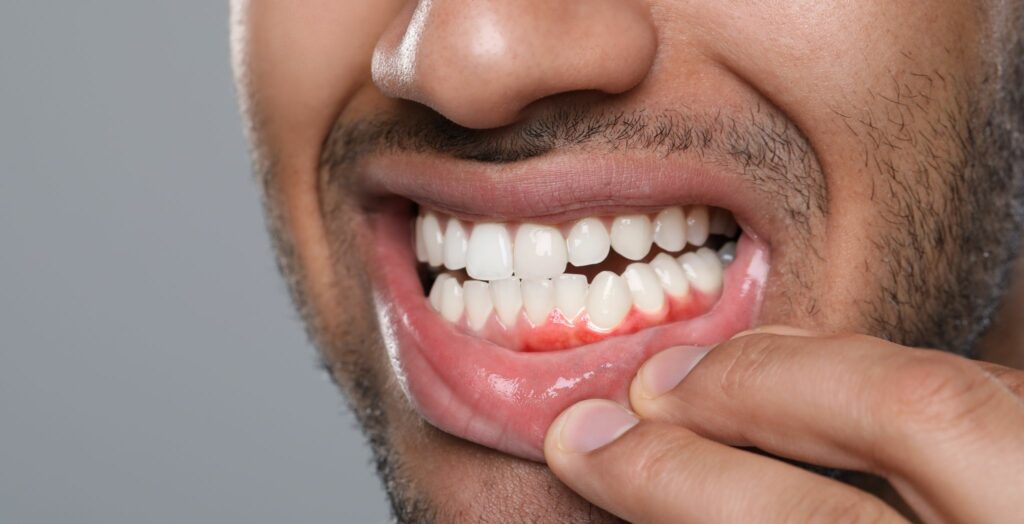 gum recession treatment options, gum recession treatment at dentist, best gum recession treatment, non-surgical gum recession treatment, surgical gum recession treatment, gum recession treatment for sensitive teeth, advanced gum recession treatment,