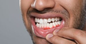 gum recession treatment options, gum recession treatment at dentist, best gum recession treatment, non-surgical gum recession treatment, surgical gum recession treatment, gum recession treatment for sensitive teeth, advanced gum recession treatment,
