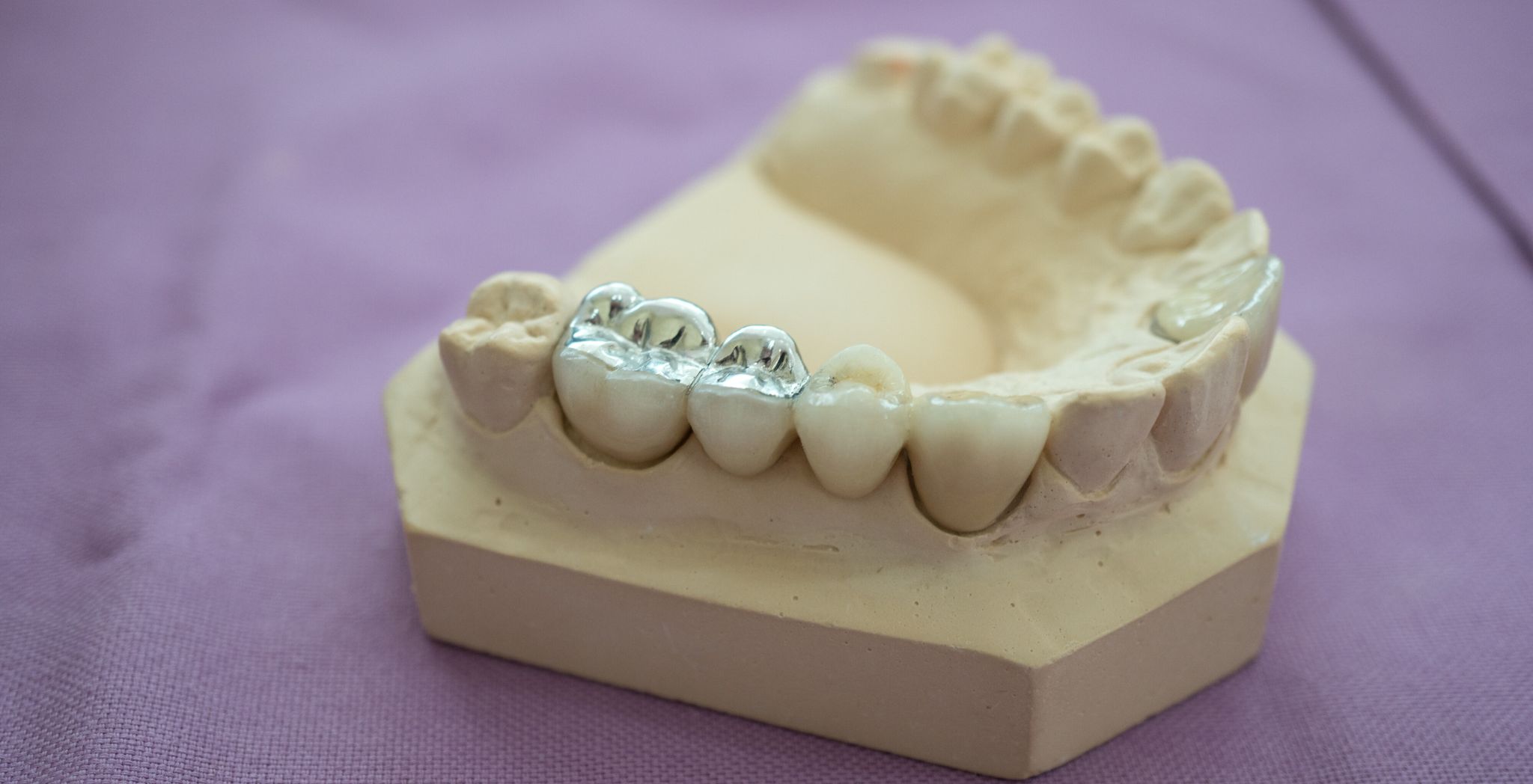 How long does a cavity filling last, Cavity filling lifespan, Longevity of dental fillings, Dental filling durability, Average life of a tooth filling, How long do fillings last, Maintaining dental fillings,