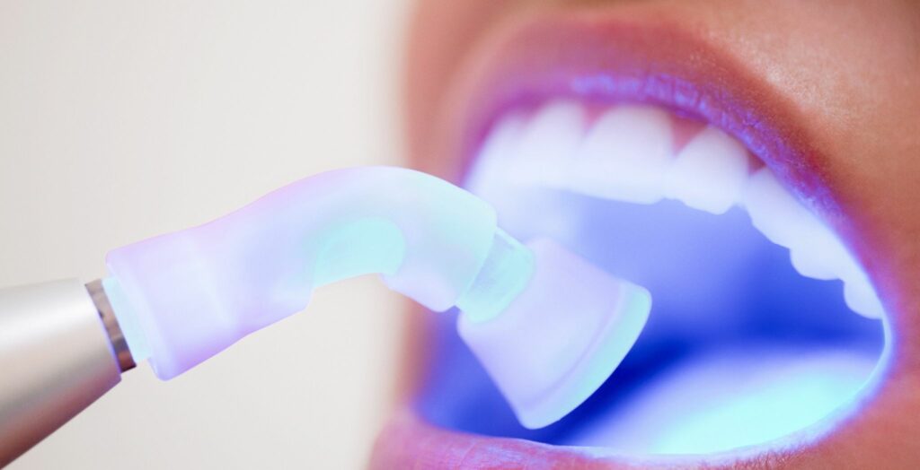 Dental bonding, Tooth bonding procedure, Cosmetic dental bonding, Dental bonding for chipped teeth, Dental bonding for gaps, Composite bonding for teeth, Tooth-colored bonding, Dental bonding treatment,