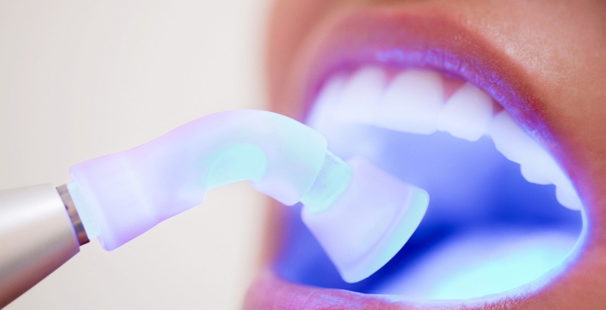 Dental bonding, Tooth bonding procedure, Cosmetic dental bonding, Dental bonding for chipped teeth, Dental bonding for gaps, Composite bonding for teeth, Tooth-colored bonding, Dental bonding treatment,