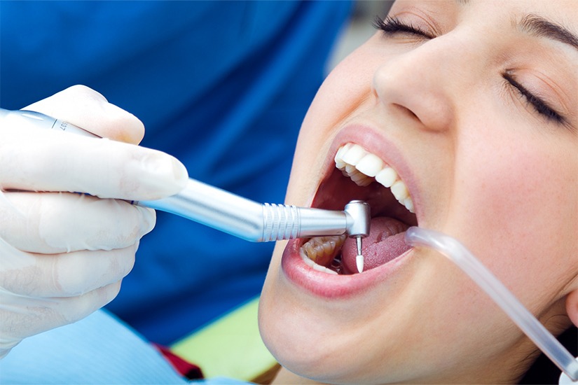 Root-Canal