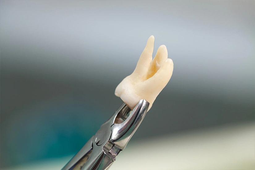 Wisdom-Tooth